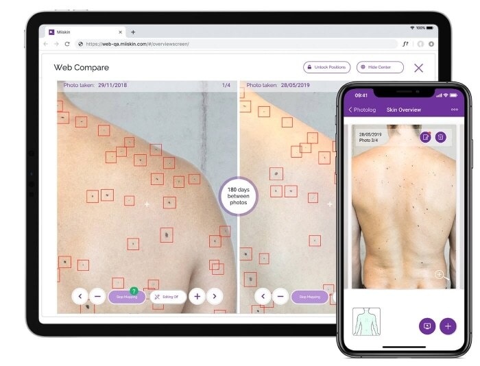 Aplikace na sledování mateřských znamének.