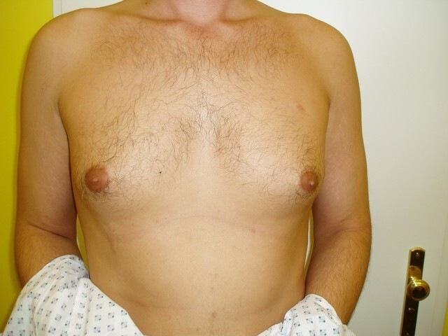 Male enlarged bust? It is becoming a civilization disease. 